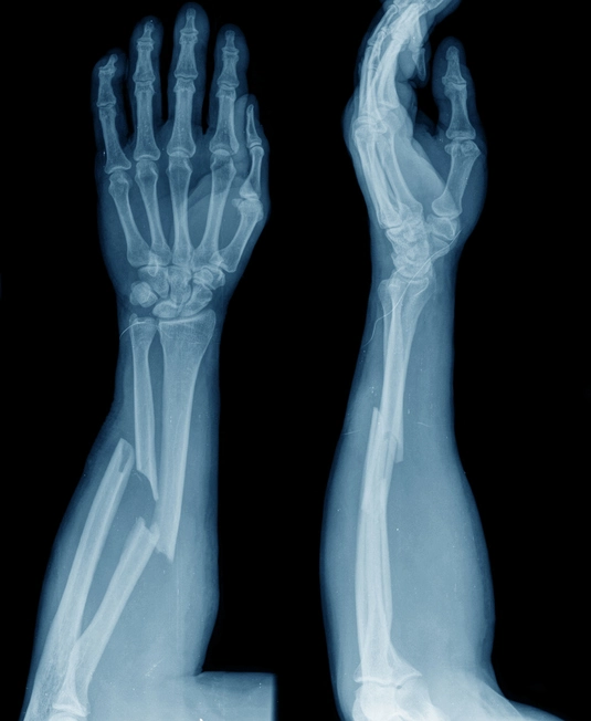 X-Rays Of Complete Compound Fractures Of Radius And Ulna In Forearm